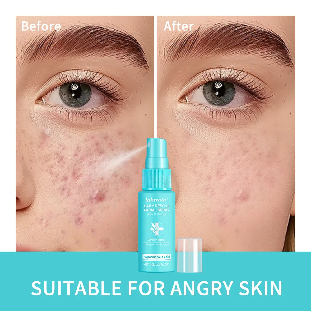 Hypochlorous Acid Facial Mist — Dermatologist's Secret